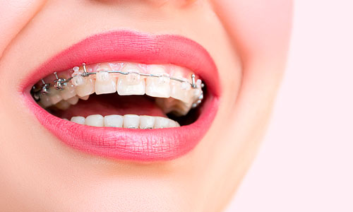 Metal Braces - Bartow, FL - Peak Dental - Straighten Teeth