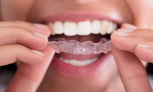 Types Of Braces, Willowbrook Braces, Braces Burr Ridge, Braces Westmont, Darien Braces, Westmont Braces, Braces Darien, Burr Ridge Braces