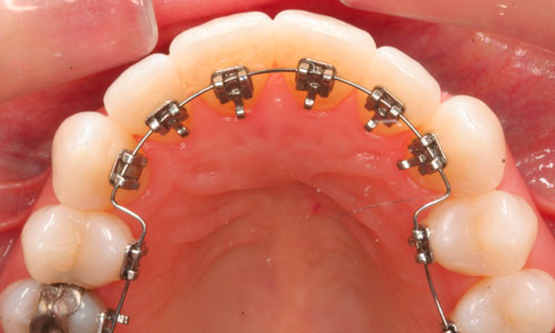 Lingual Braces