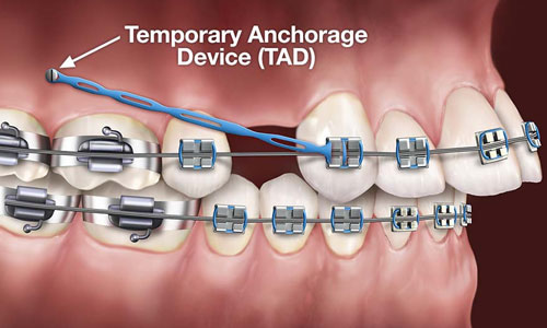 Types of Braces - Whistler Orthodontic Center