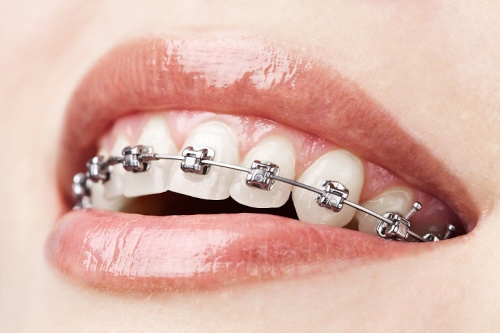 Braces Darien